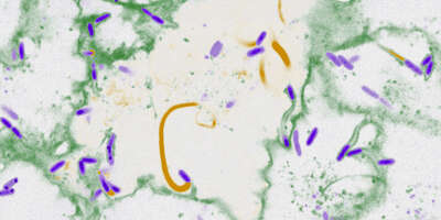 Der Erreger Burkholderia thailandensis (violett) verwendet Zellbestandteile (gelb), um die Membran von einer Wirtszelle (grün) in die benachbarte auszustülpen.