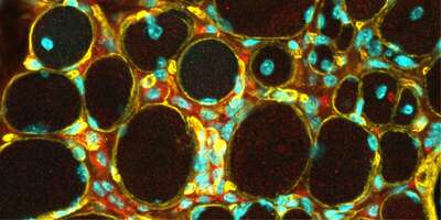 Muscle cross section showing muscle fiber degeneration in LAMA2-related muscular dystrophy. 