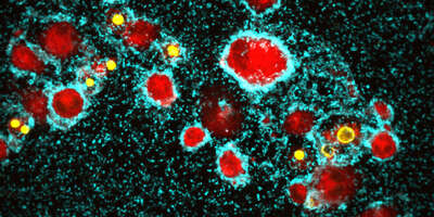 Cholera-Erreger (blau) bilden einen aggressiven Biofilm auf Immunzellen (rot).